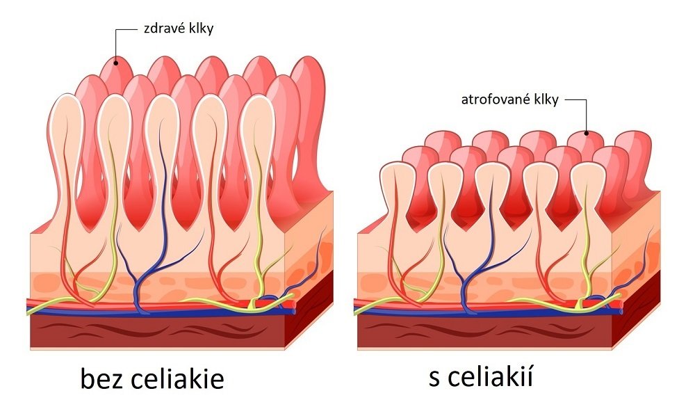 atrofované klky střeva u celiaků